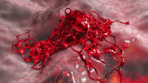 Invasive cancer growth, 3D animation showing tumor invasion into surrounding and underlined tissues