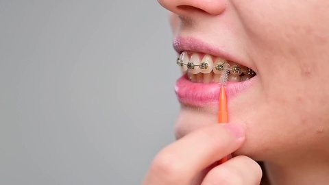 Unrecognizable Caucasian woman cleans braces with a brush. Close-up of female teeth with brackets