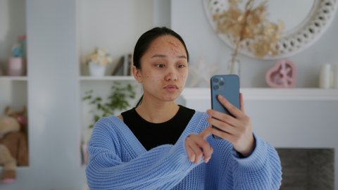 Young Beautiful Asian Girl with acne before treatment. Girl with problem skin looks at the phone and touches the skreen. Commercial ready woman skin care concept.