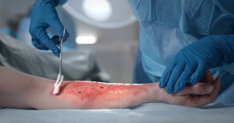 Surgeons team working with burn wound on arm of patient in operating room. Close up of medics disinfecting burn wound of patient in operating room