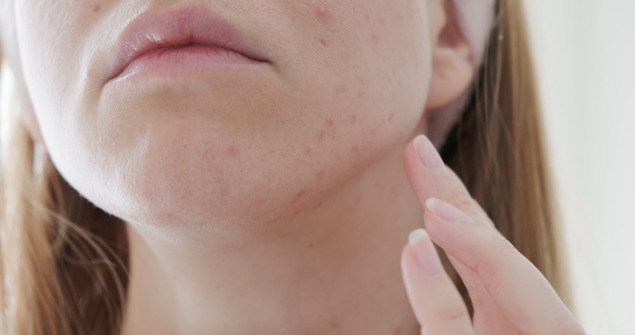 Close up of sad woman touching acne on her face.  | Shutterstock HD Video #1070043055
