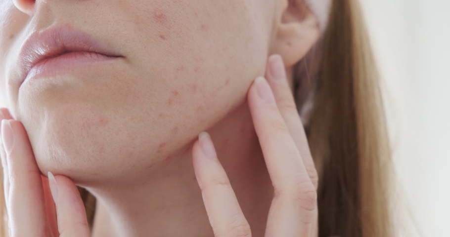 Close up of sad woman touching acne on her face.  Royalty-Free Stock Footage #1070043055