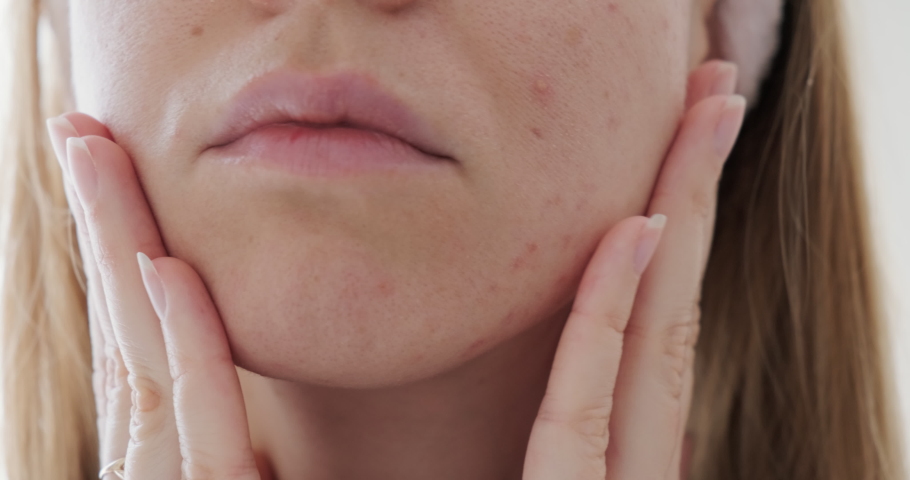 Close up of sad woman touching acne on her face.  Royalty-Free Stock Footage #1070060995