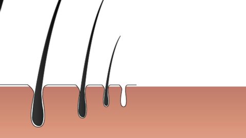 Stages of hair loss, fall:
With hair follicles getting smaller, the hair shaft starts getting thinner in every growth cycle, reducing them to soft and light hair and eventually complete disappearance.