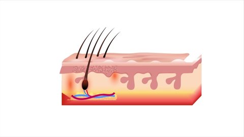 Shrinking of hair follicles result in hair loss, baldness, alopecia. The diagram represents this decrease of follicle size contributing to hair fall. 