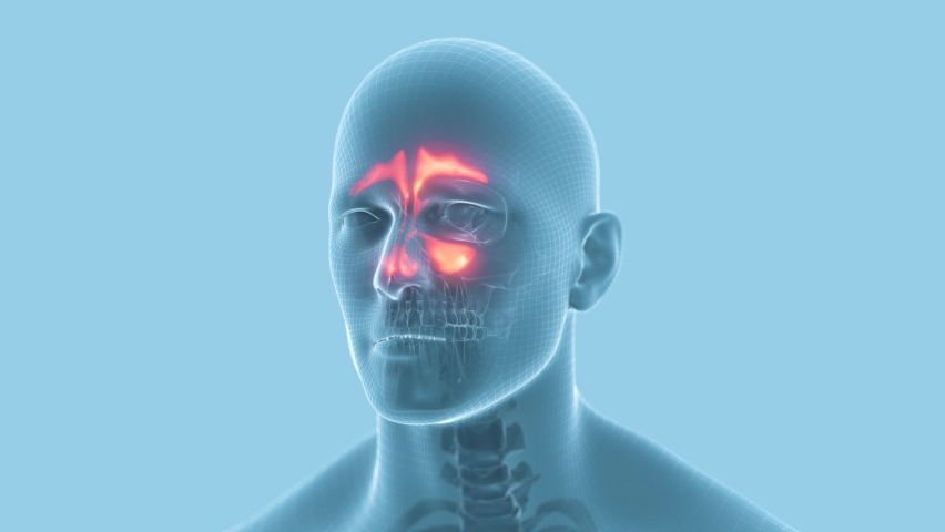 Inflammation of mucous membranes of nasal sinus.
3d animation X-ray human head whith sinusitis. Royalty-Free Stock Footage #1070139667