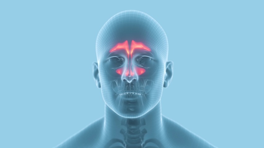 Inflammation of mucous membranes of nasal sinus.
3d animation X-ray human head whith sinusitis. | Shutterstock HD Video #1070139667