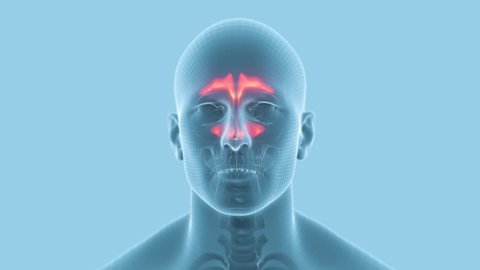 Inflammation of mucous membranes of nasal sinus.
3d animation X-ray human head whith sinusitis.