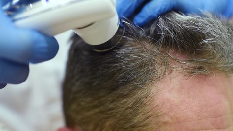 a doctor in a modern dermatological clinic makes a diagnosis of the structure and condition of a man's hair with a special device - a trichoscope.