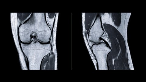  MRI Knee  joint or magnetic resonance imaging of the knee compare PDW Coronal and sagittal plane  for diagnosis sport trauma and damage of anterior cruciate ligament (ACL)