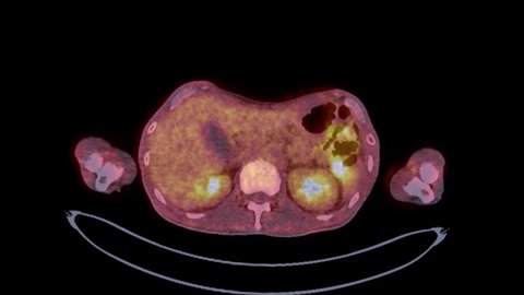  PET CT ( Positron Emission Tomography )  of whole human body 3d rendering image red color tone axial view for detect tumor recurrence after surgery.