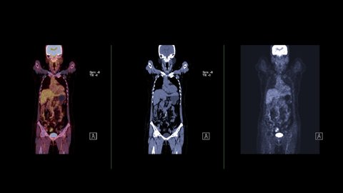 Collection PET CT ( Positron Emission Tomography )  of whole human body 3d rendering image red color tone compare coronal view for detect tumor recurrence after surgery.