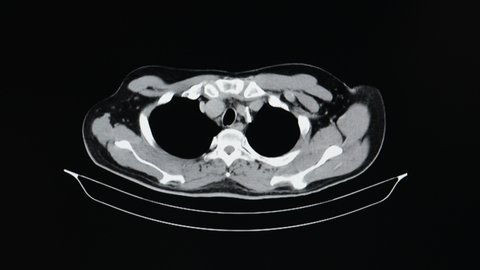 A motion CT scan of an abdomen of a patient with a stent graft replacement at aortic arch and  aortic dissections at thoracic and abdominal aorta with intimal tears. Diagnostic CT footage.