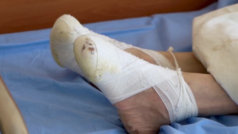 a man is in hospital in bed with amputated limbs from diabetes
