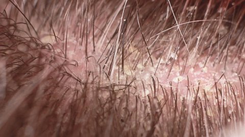 Macro video of human hair with dandruff. Head wounds and itching, hair care, seborrheic treatment