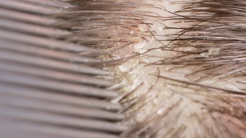 Macro video dander on dark brunette hair. The problem of dried scalp, wrong shampoo, fungus on the head