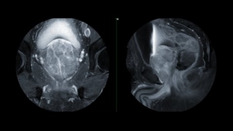Compare of MRI prostate gland Coronal and sagittal T1 fat suppression after injection gadolinium contrast for diagnosis prostate cancer cell in aged men.