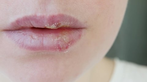 Close up of girl lips affected by herpes. Treatment of herpes infection and virus. Part of young woman face, lips with herpes affected. Beauty dermatology concept