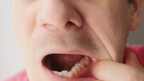 Man is showing tooth in mouth with a dental abscess fistula on gum, closeup view. Tooth with a temporary filling seal. He presses it with finger. Dental treatment of the internal parts of the tooth.