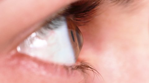Macro eye video. Keratoconus - eye disease, thinning of the cornea in the form of a cone. The cornea plastic