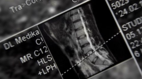 MRI image of the lumbar spine of patient complaining of pain. Macro. Closeup