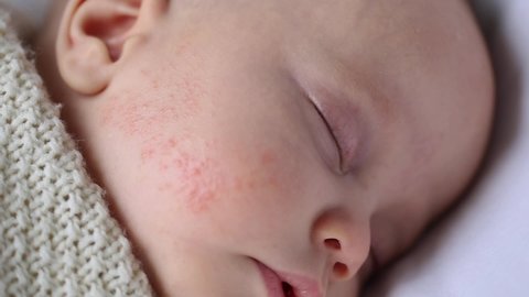 atopic dermatitis allergic skin red rash pimples on baby's cheek face close-up view