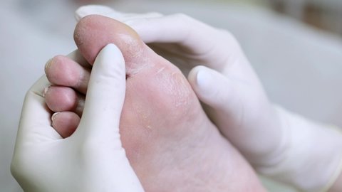 A dermatologist examines the foot of a diabetic patient. Problematic diabetic foot with cracks and scaling. Medical hardware pedicure in the salon. Diseases of the skin.