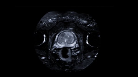 MRI prostate gland for diagnosis prostate cancer cell in aged men.