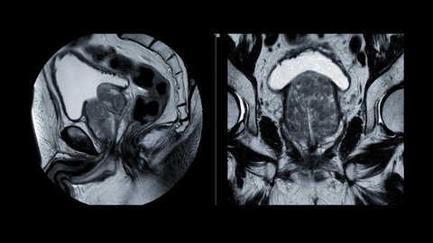 MRI prostate gland Sagittal T2W View for diagnosis prostate cancer cell in aged men.