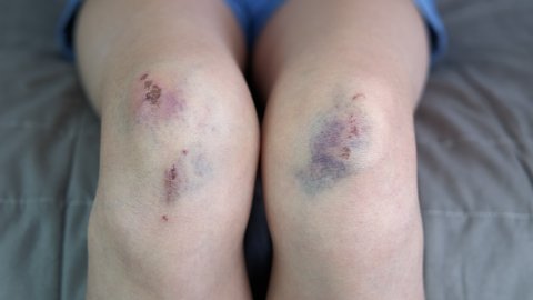 Injure of child legs. A child show her injures and bruises on legs after family abuse in the room.