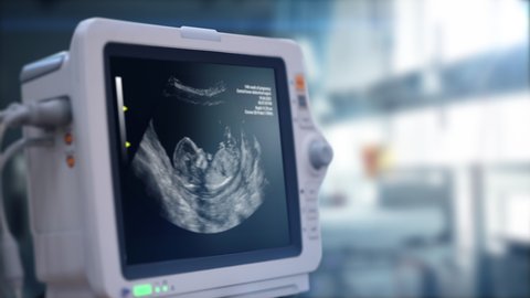 Sonogram of human fetus. A doctor is viewing an ultrasound result at a display in a hospital. Ultrasound machine monitor in clinic