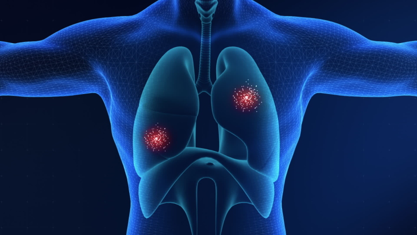 Lungs Cancer and chest infection Visualization, It can be used in medical projects, documentaries, etc.  Royalty-Free Stock Footage #1071745282