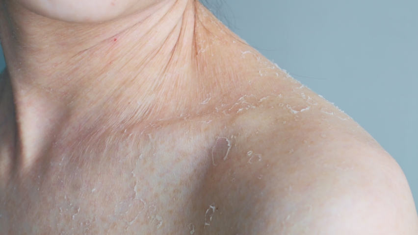 Age-related skin changes appear on the woman's body, wrinkles and dryness on the neck. It is necessary to nourish the skin with a cream. Problem skin. Body care. Close-up. Royalty-Free Stock Footage #1071760522