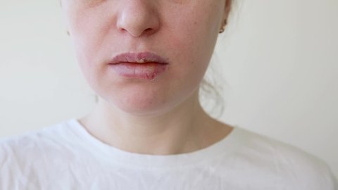 Close up of girl lips affected by herpes. Treatment of herpes infection and virus. Part of young woman face with finger touching pain on lips with herpes affected. Beauty dermatology concept.