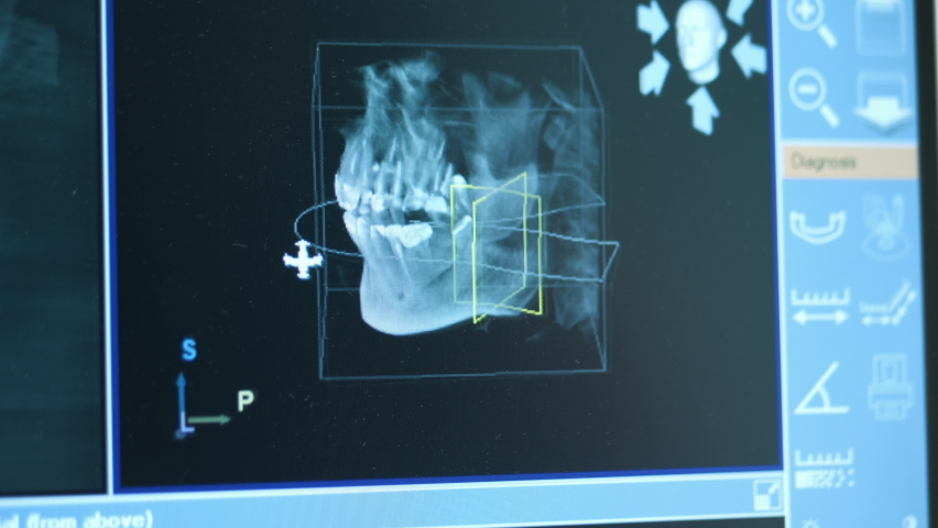 Close-up of doctor dentist looks at looks 3d model of x-rays of the patient's jaw and teeth on the monitor, modern dentistry Royalty-Free Stock Footage #1071869968