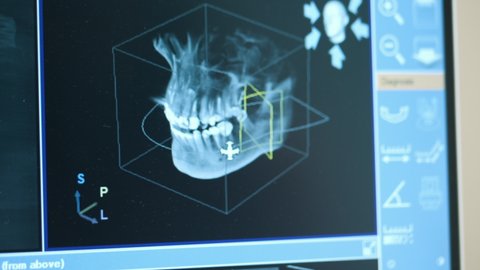 Close-up of doctor dentist looks at looks 3d model of x-rays of the patient's jaw and teeth on the monitor, modern dentistry