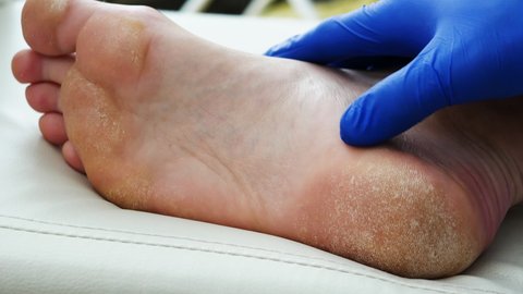 Dry skin, Psoriasis of the foot The skin is damaged. Dermatitis, eczema, psoriasis, allergic reaction. Close-up of peeling and cracked foot in a person. Fungal infection or athlete's foot, sweaty feet.