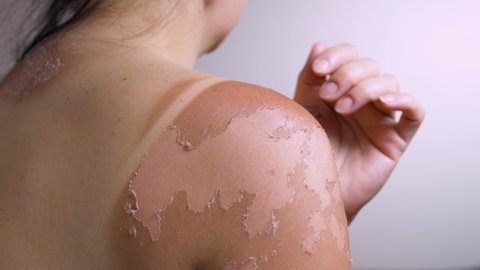 The woman scratches her shoulder with her hand. Red spots on the shoulder Cutaneous psoriasis. Sunburn, tanning.
