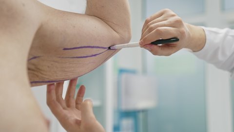 Plastic surgeon prepares a patient for liposuction surgery. Doctor draws lines on the male body with a marker.