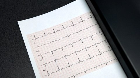 12-lead ECG normal sinus rhythm, examination report comes out of electrocardiographic printer