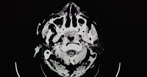A CT brain scan of a patient with epidural hematoma at right temporal convexity with mass effect. Tension pneumocephalus. Multiple facial, sinuses, and base of skull fractures.