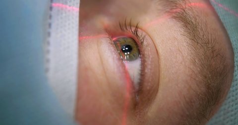 Laser vision correction. Close-up view of the patient's eye lying on the operating table before ophthalmic operation in the operating room.
