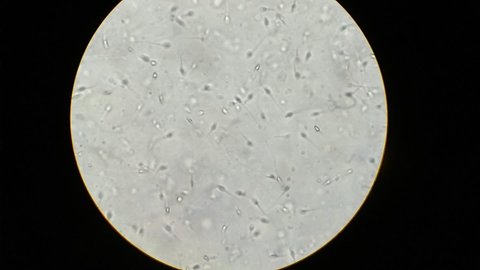 Semen analysis, sperm analysis on microscopic examination. Micrograph of Oligospermia