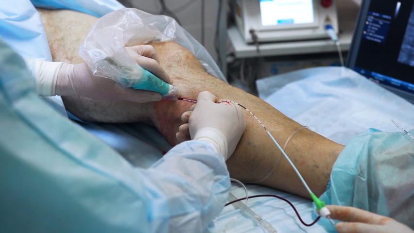 The surgeon performs the operation on the legs with the help of innovative technologies - laser. Treatment of varicose veins promptly, close up. A phlebologist treats a patient. Royalty-Free Stock Footage #1072555703