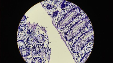 Colon Cancer: Videography (microscopic video) of colonic adenocarcinoma,Light microscope 200x showing colon adenocarcinoma. 