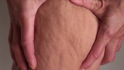 Demonstrating cellulite on thigh close up
