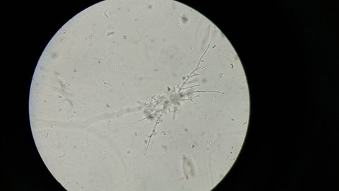 Fungal Yeast, Budding yeast and pseudohyphae of Candida albicans, stained with periodic acid-Schiff (PAS) stain. This fungus commonly affects vagina and vulva, oral (thrush) and diaper rash.Video