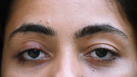 Closeup shot of face of Indian woman with one eye infection, upper eyelid style with nodule. Concept of health, disease and treatment	
