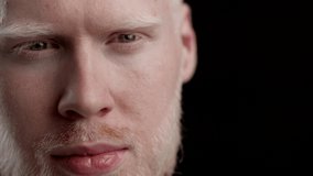 Albino Man Looking At Camera Posing On Black Background. Closeup Studio Portrait, Unusual People Headshot. Albinism Genetic Disorder And Poor Eyesight Problem. Cropped, Selective Focus
