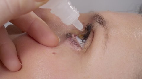 CLOSE UP: Unrecognizable young woman applies eyedrops to her irritated eye. Adult Caucasian female drops eye medicine into her dry left eye. Detailed shot of woman's eye during eyedrop application.